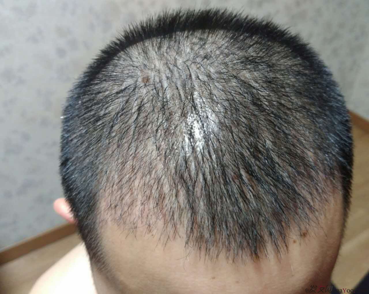 m型植发大概要多少钱 植发有用吗,可以维持多久