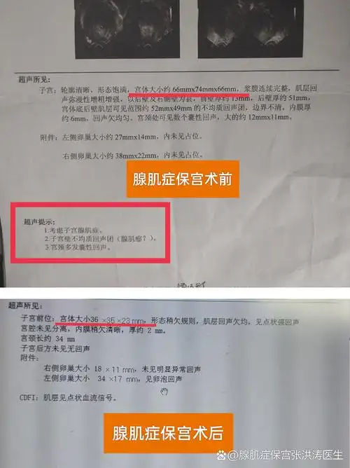 子宫增厚多少会来月经 子宫增厚多少会来月经