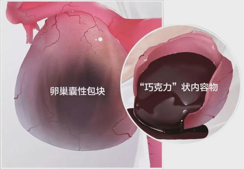 来月经血块特别多是怎么回事 来月经血块特别多是怎么回事