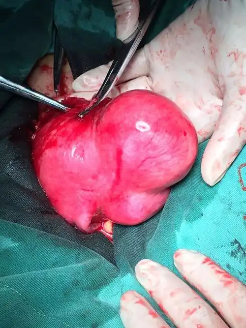 宫外孕一定要开刀吗 宫外孕一定要开刀吗