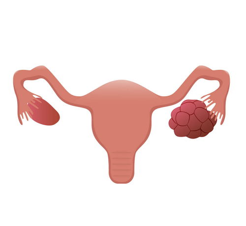 超声消融可治多大的子宫肌瘤?聚焦超声治疗的效果如何? 超声消融可治多大的子宫肌瘤?聚焦超声治疗的效果如何?