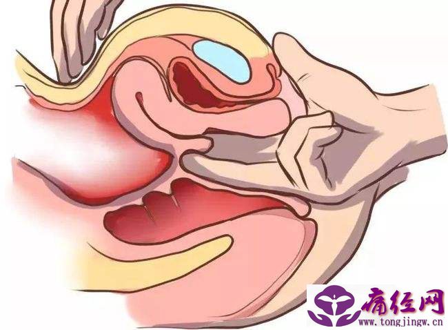 宫颈炎的症状有哪些 这些表现要警惕 宫颈炎的症状有哪些 这些表现要警惕