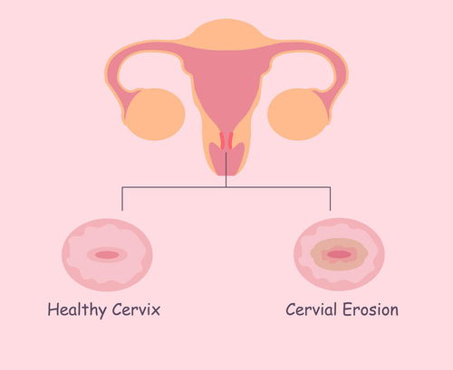 月经延迟量大 月经量大推迟 月经延迟量大 月经量大推迟