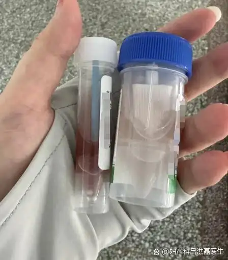 子宫肌瘤早期症状有哪些明显的表现? 子宫肌瘤早期症状有哪些明显的表现?